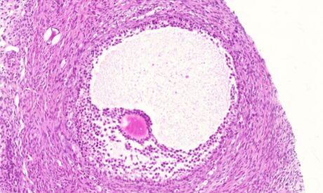Read our article : "Cryopreservation of mature and immature oocytes"